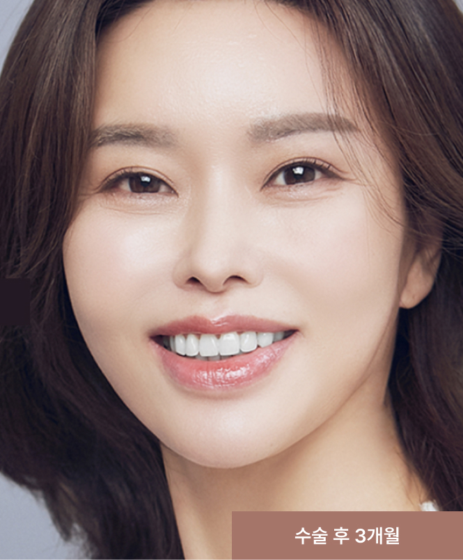 광대뼈수술 과정 2