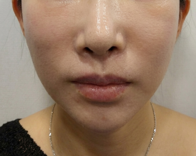 Before