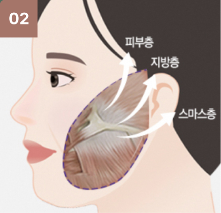광대뼈수술 과정 2