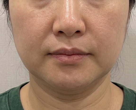 턱라인이 이상한 경우