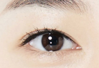 수술 후